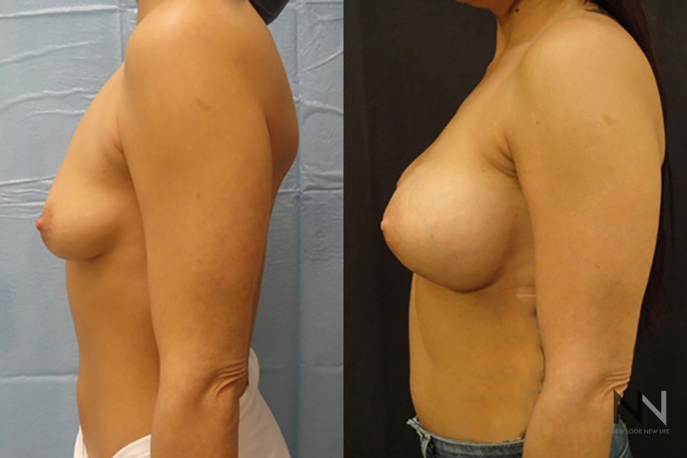 Breast augmentation before and after symmetry improvement - Angle 3