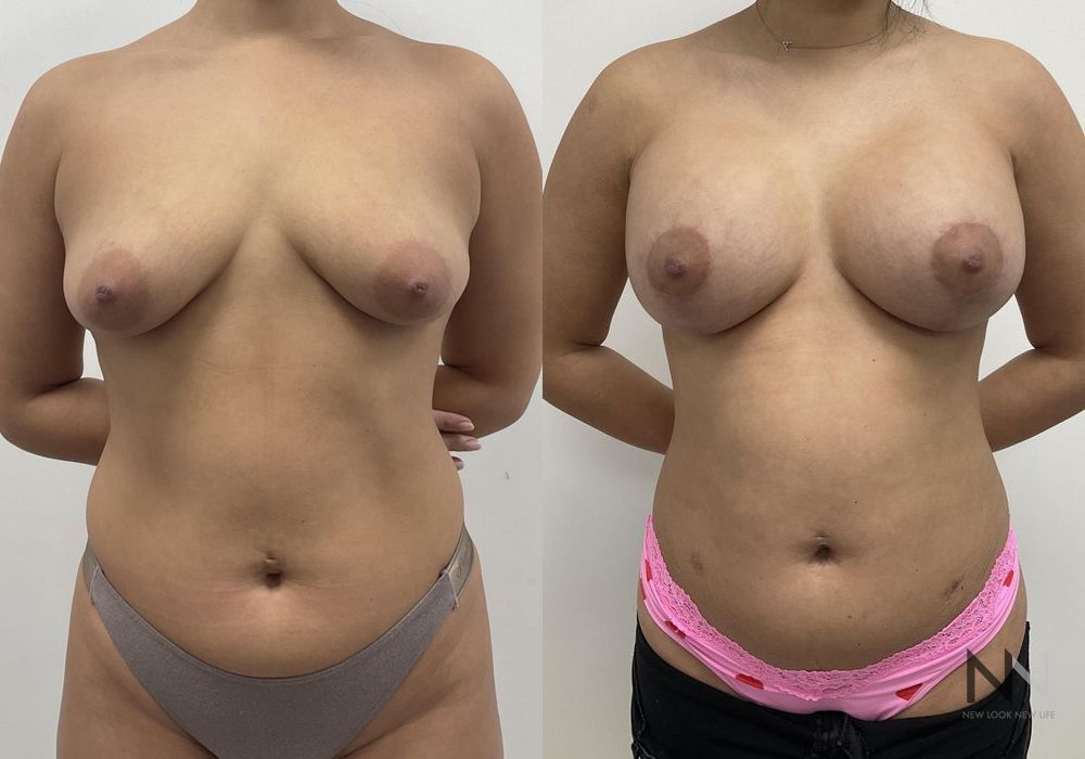 Breast Augmentation - Thumbnail 8