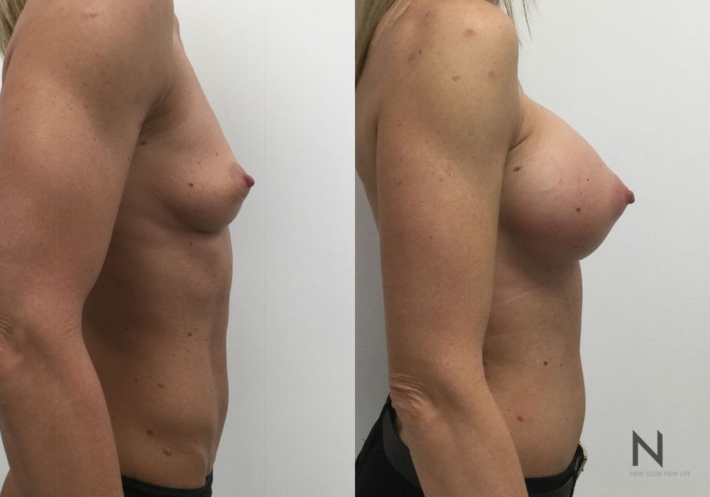 Breast Augmentation - Thumbnail 2