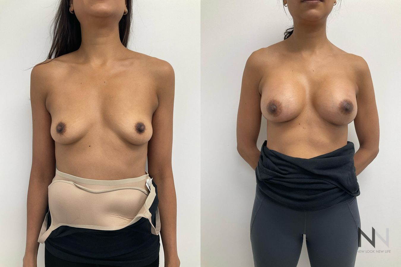 Breast augmentation before and after symmetry improvement