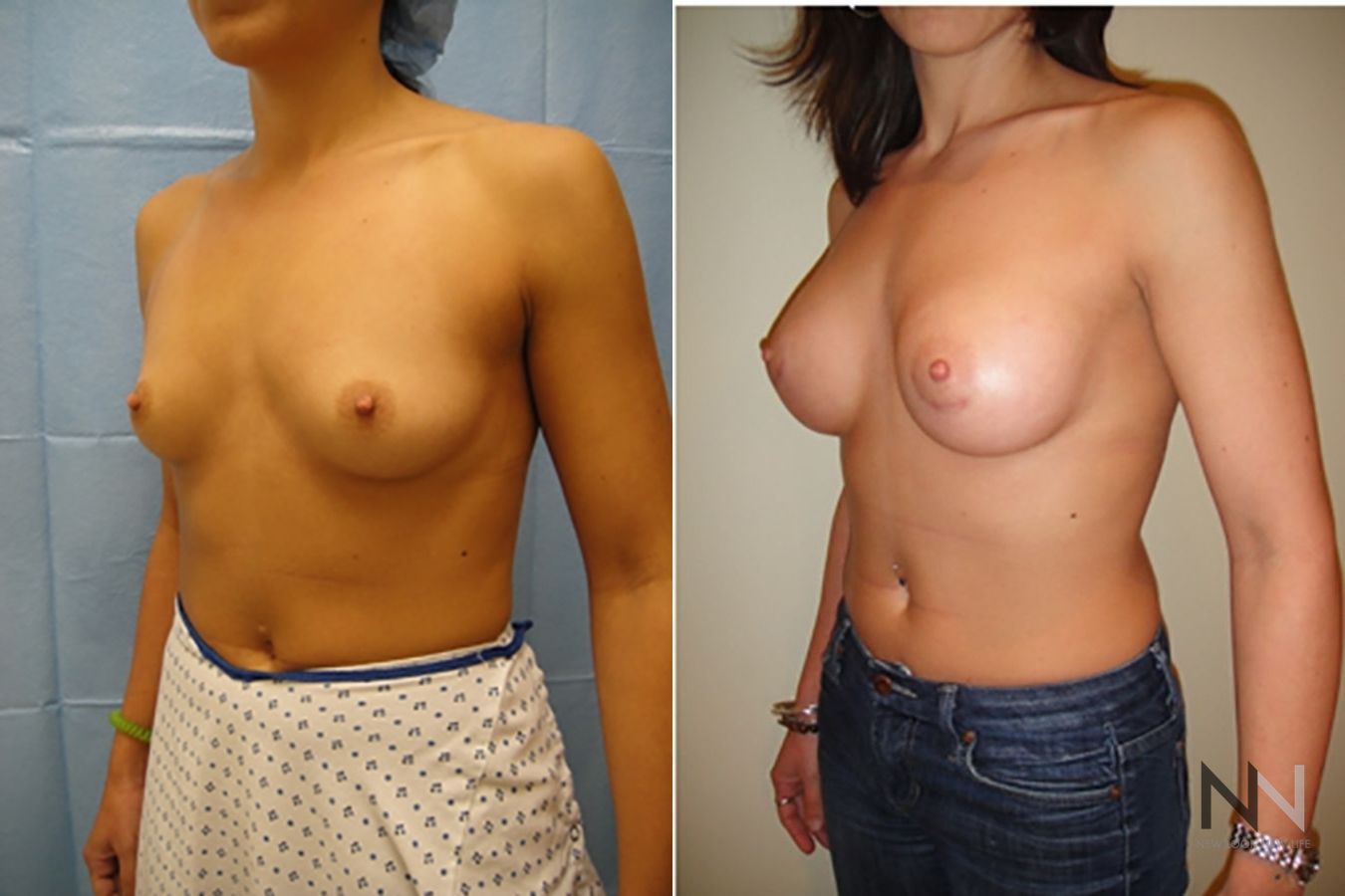 Breast contour enhancement six months post-op - Angle 2