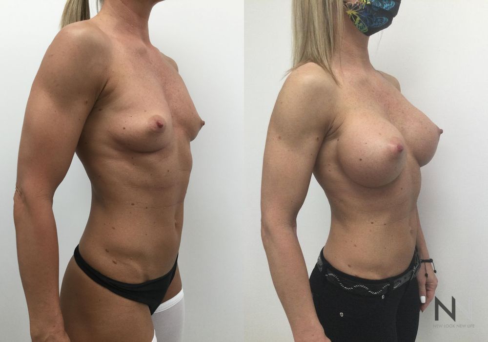 Breast Augmentation - Thumbnail 2