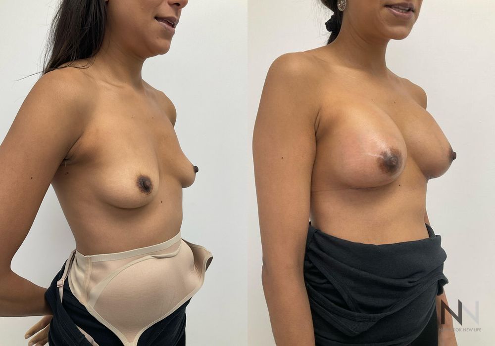 Breast Augmentation - Thumbnail 2