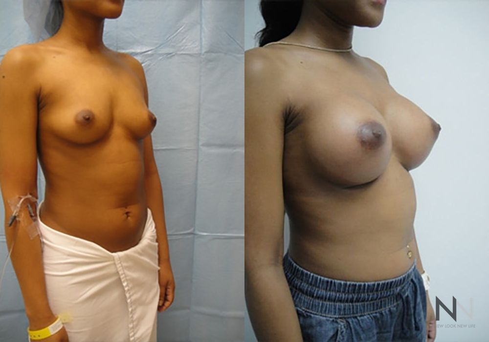 Breast Augmentation - Thumbnail 4