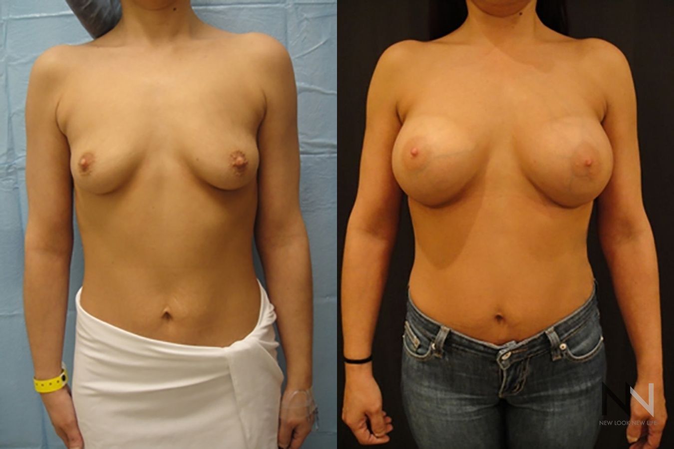 Breast augmentation before and after symmetry improvement