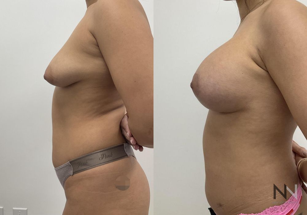 Breast Augmentation - Thumbnail 3