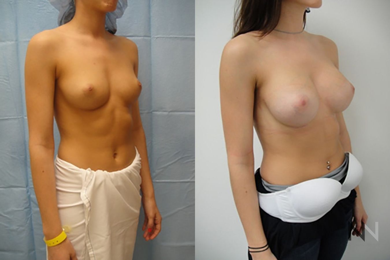 Before and after breast augmentation showing increased volume - Angle 4