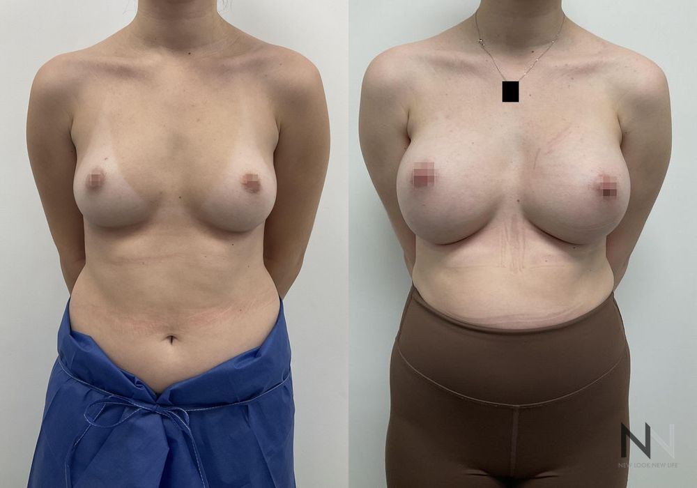 Breast Augmentation - Case 2008
