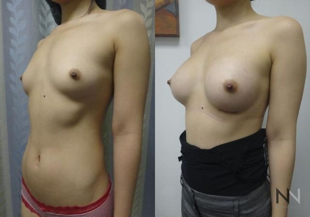 Breast Augmentation - Thumbnail 2