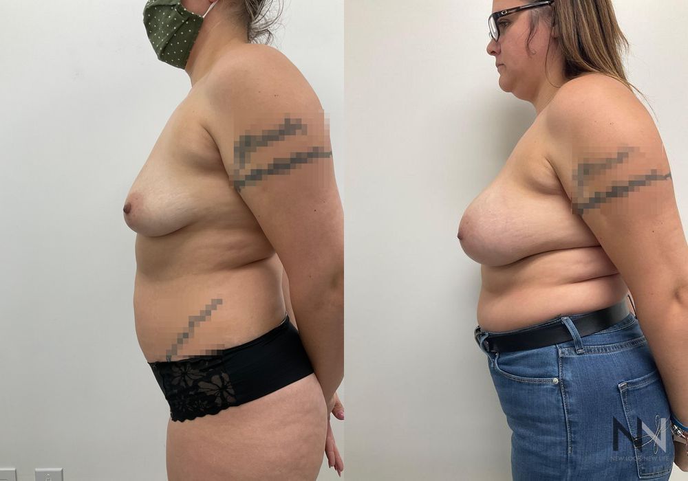 Breast Lift - Thumbnail 3