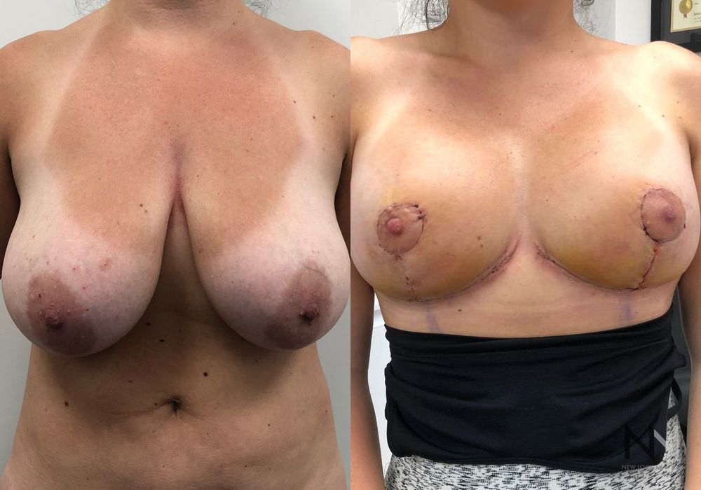 Breast Lift - Case 1839
