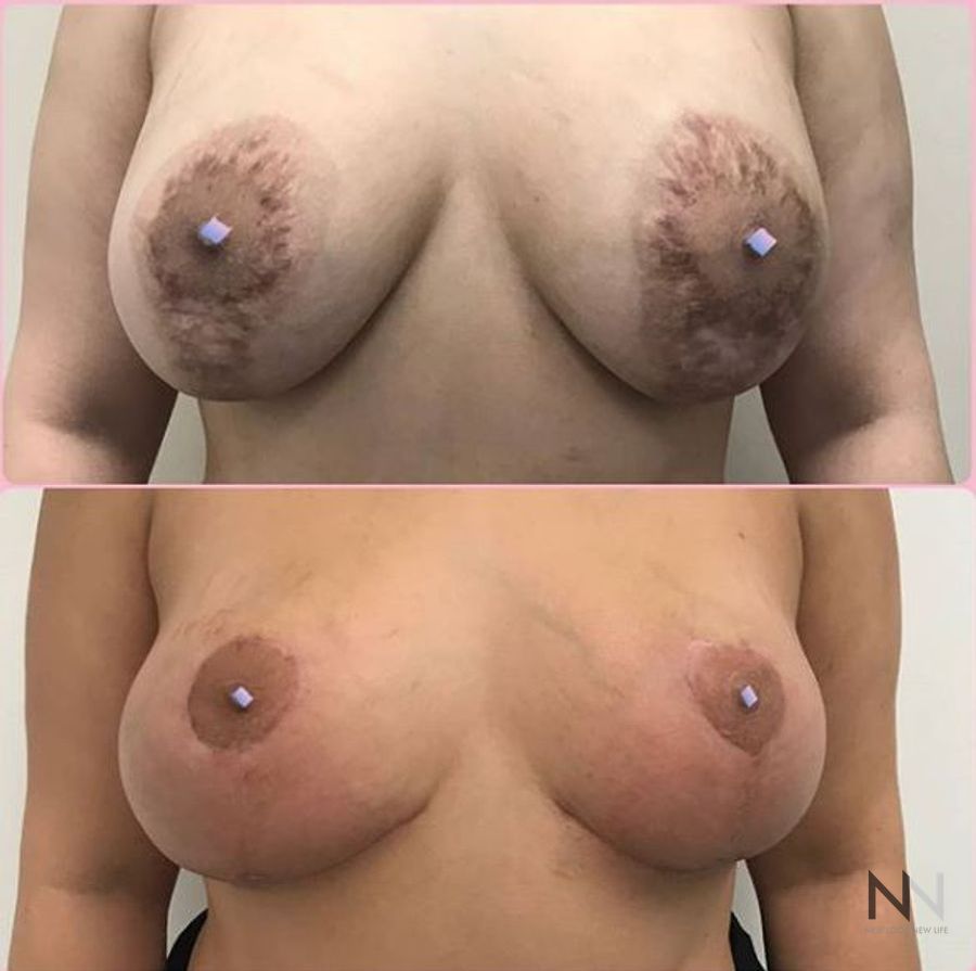 Breast lift results with improved symmetry and balance