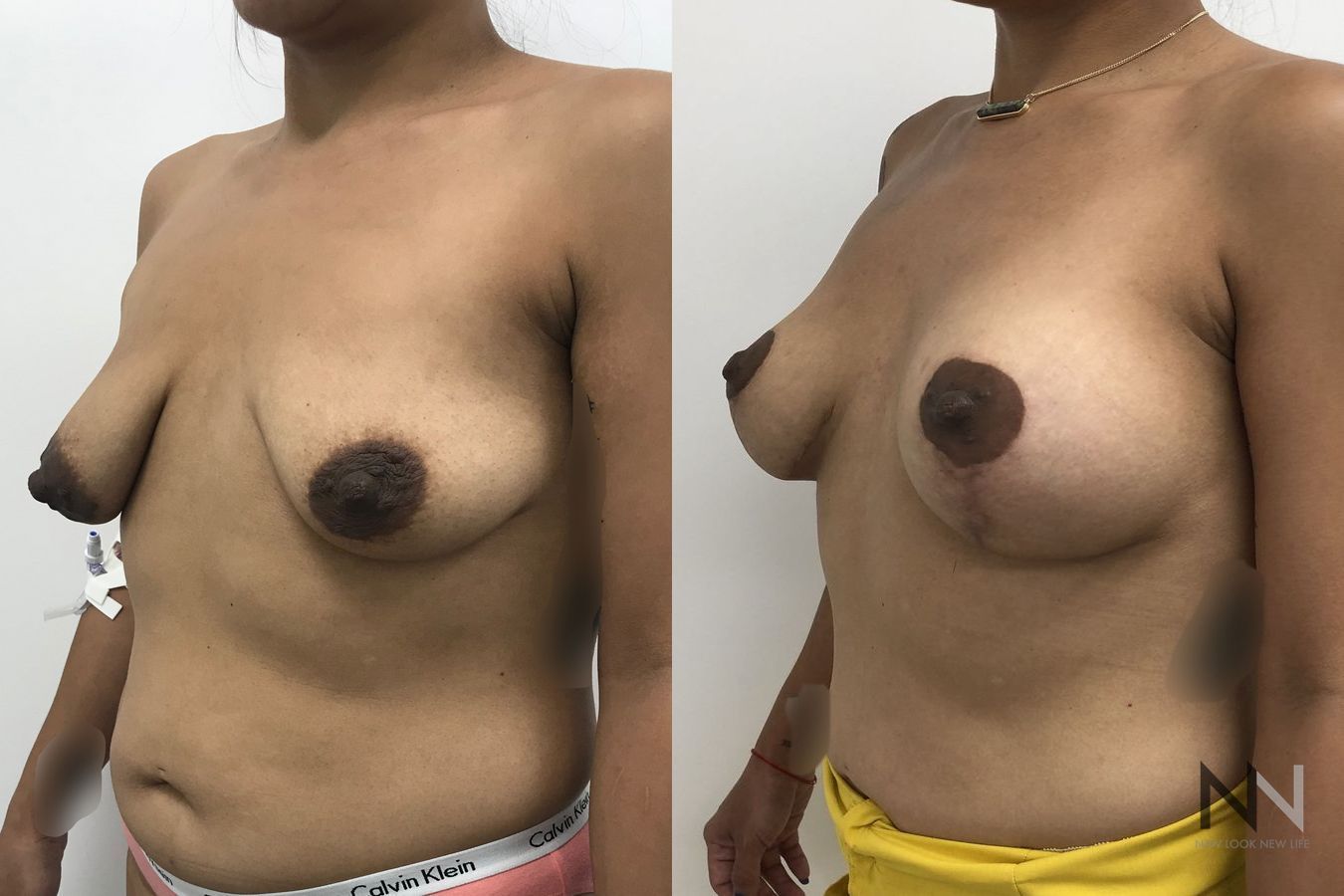 Mastopexy with augmentation showing improved contour - Angle 3