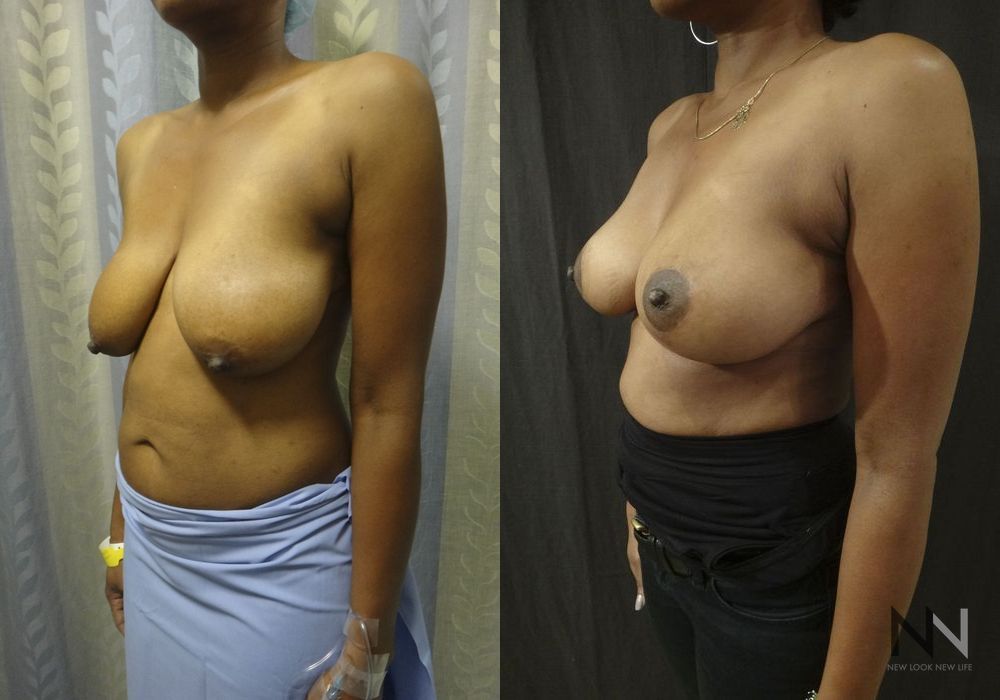 Breast Lift - Thumbnail 3