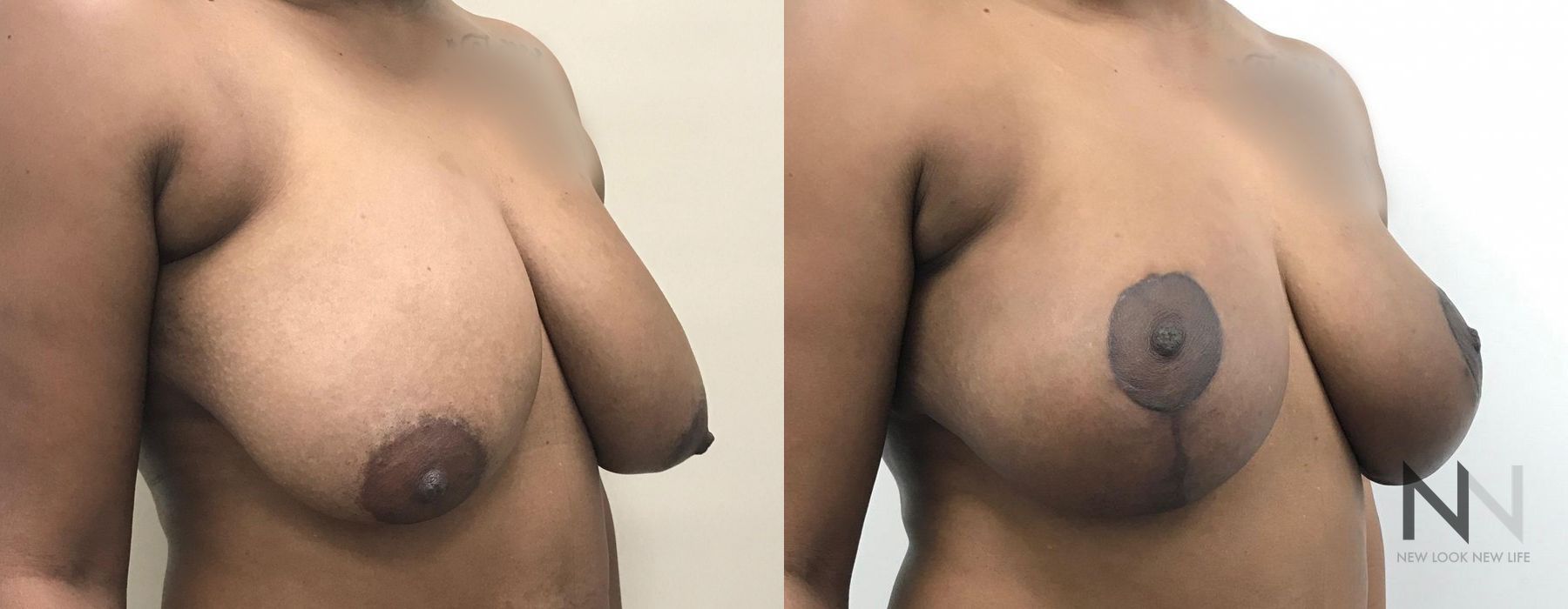 Breast Lift - Thumbnail 3