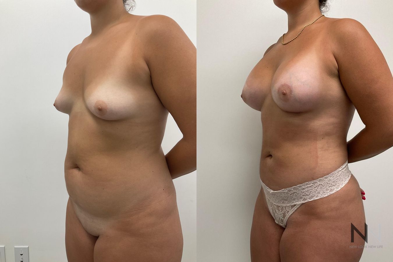 Before and after breast augmentation six months results
