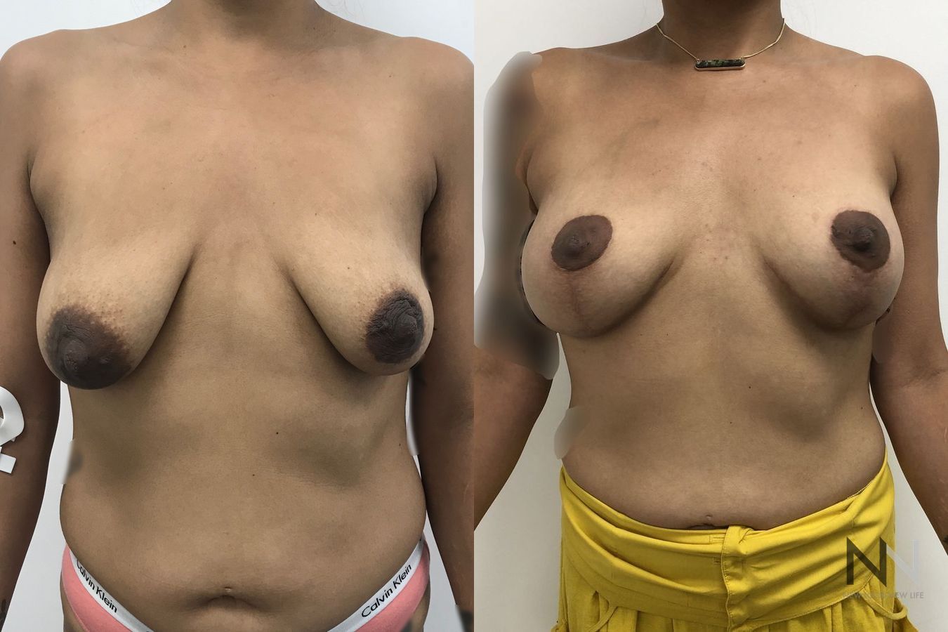 Mastopexy with augmentation showing improved contour