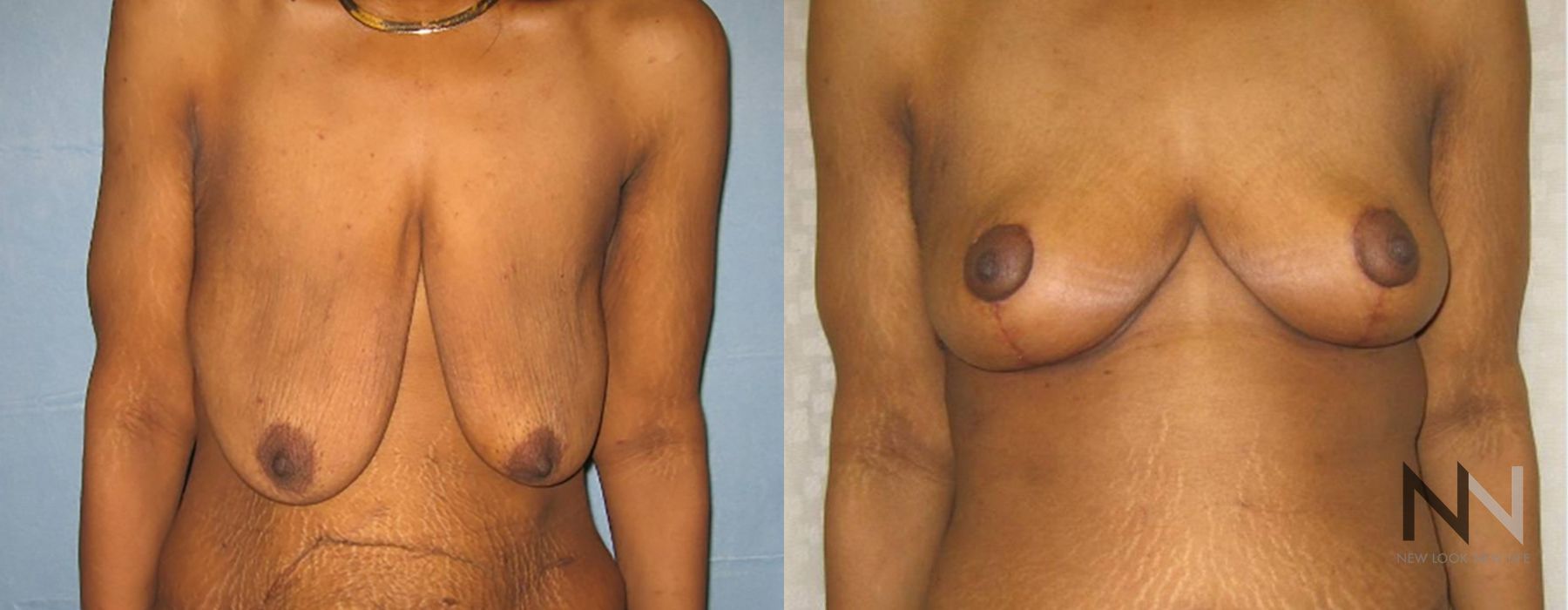 Breast Lift - Thumbnail 2