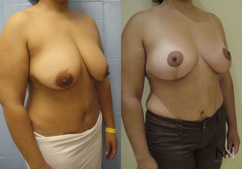 Breast Lift - Thumbnail 2
