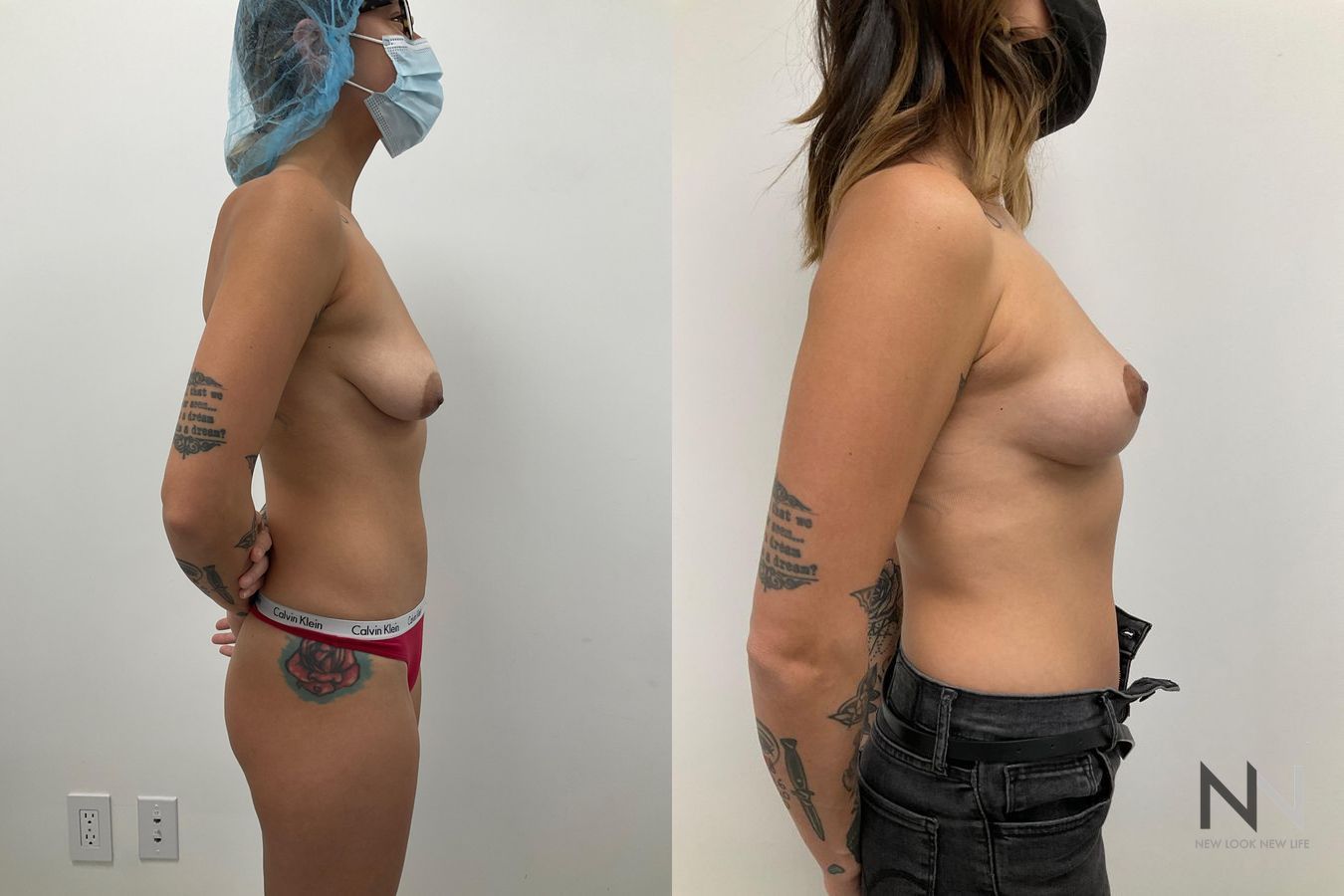 Before and after breast lift six months results - Angle 3