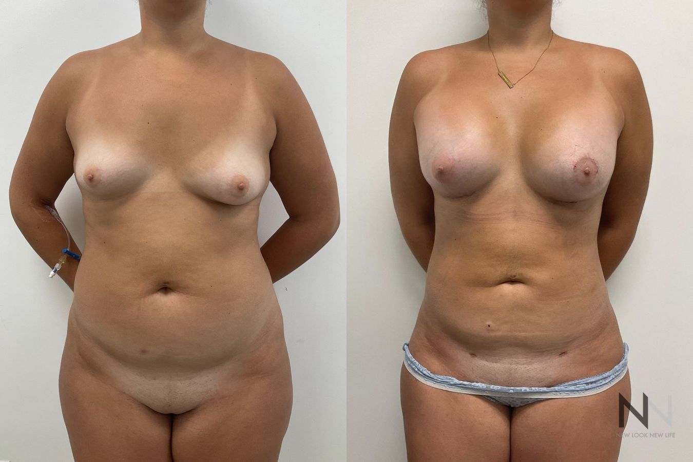 Before and after breast augmentation six months results - Angle 2