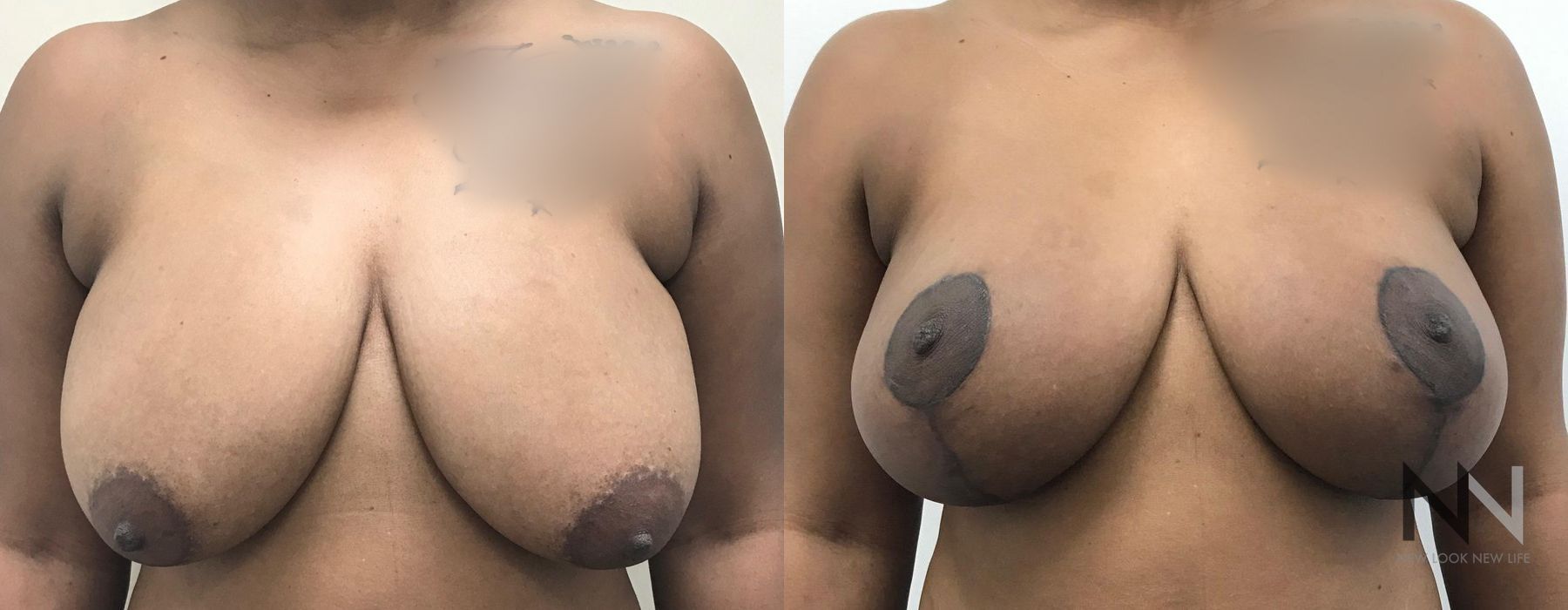 Breast Lift - Thumbnail 2