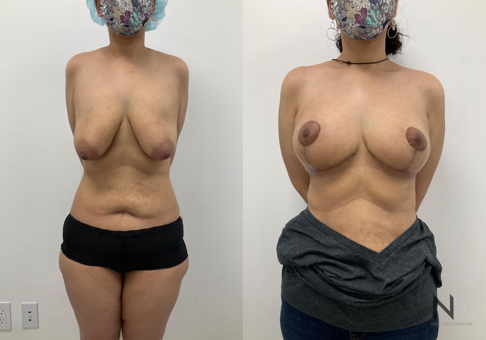Breast Lift - Case 2034