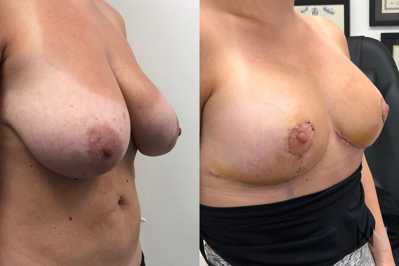 Breast contour improvement after reduction surgery - Angle 2