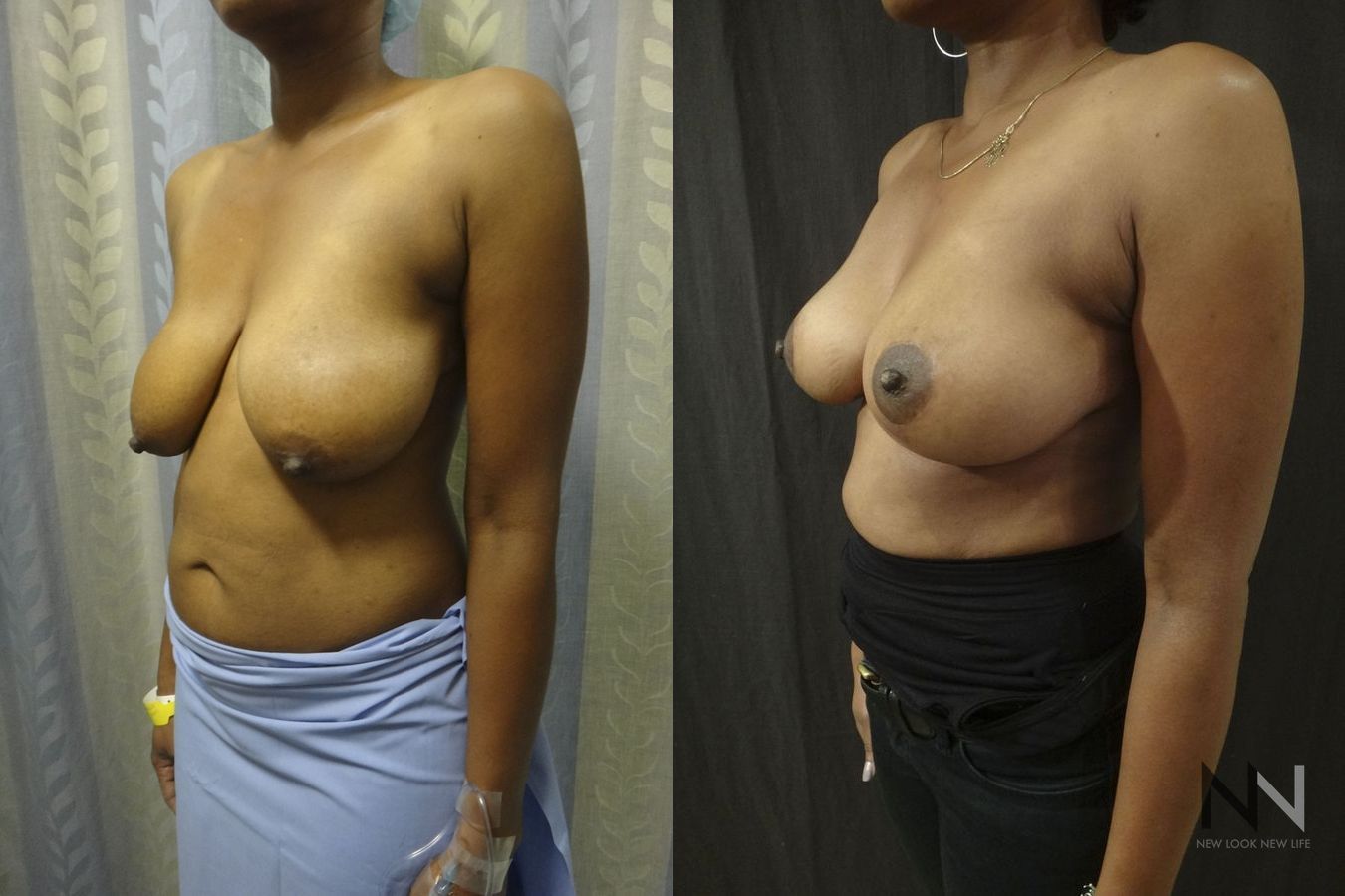 Breast contour improvement after mastopexy surgery - Angle 2