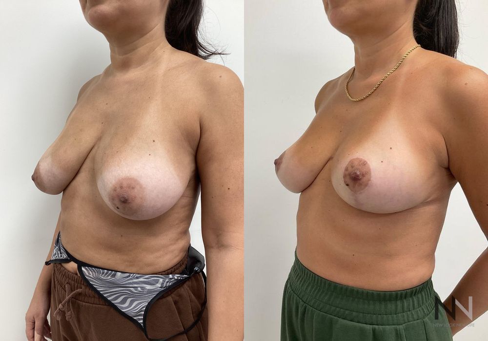 Breast Lift - Thumbnail 2