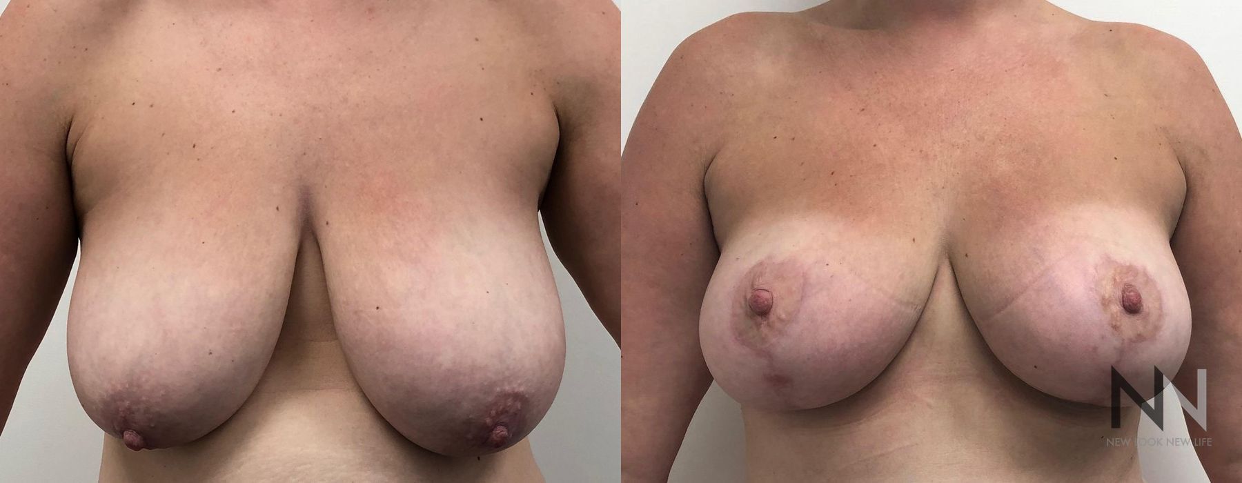 Breast Lift - Case 2031