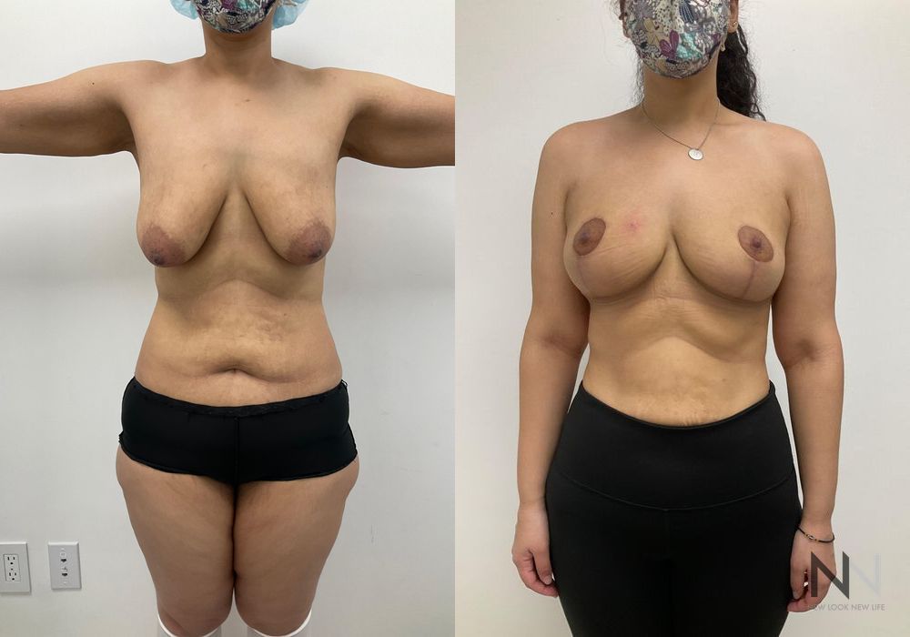 Breast Lift - Thumbnail 2