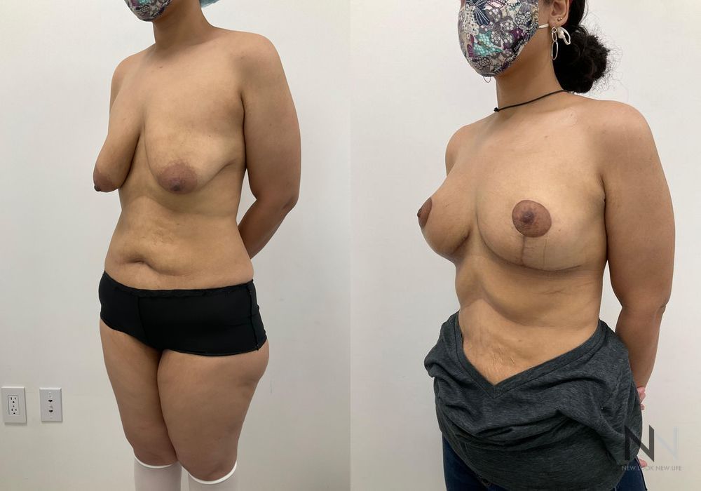Breast Lift - Thumbnail 3