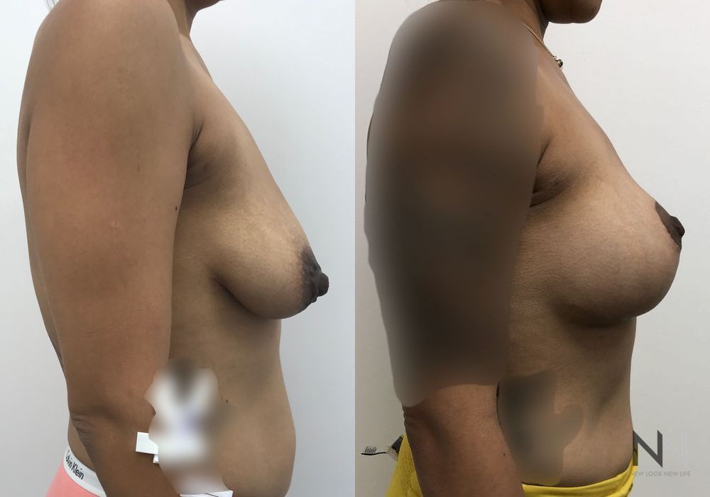 Breast Lift - Thumbnail 3