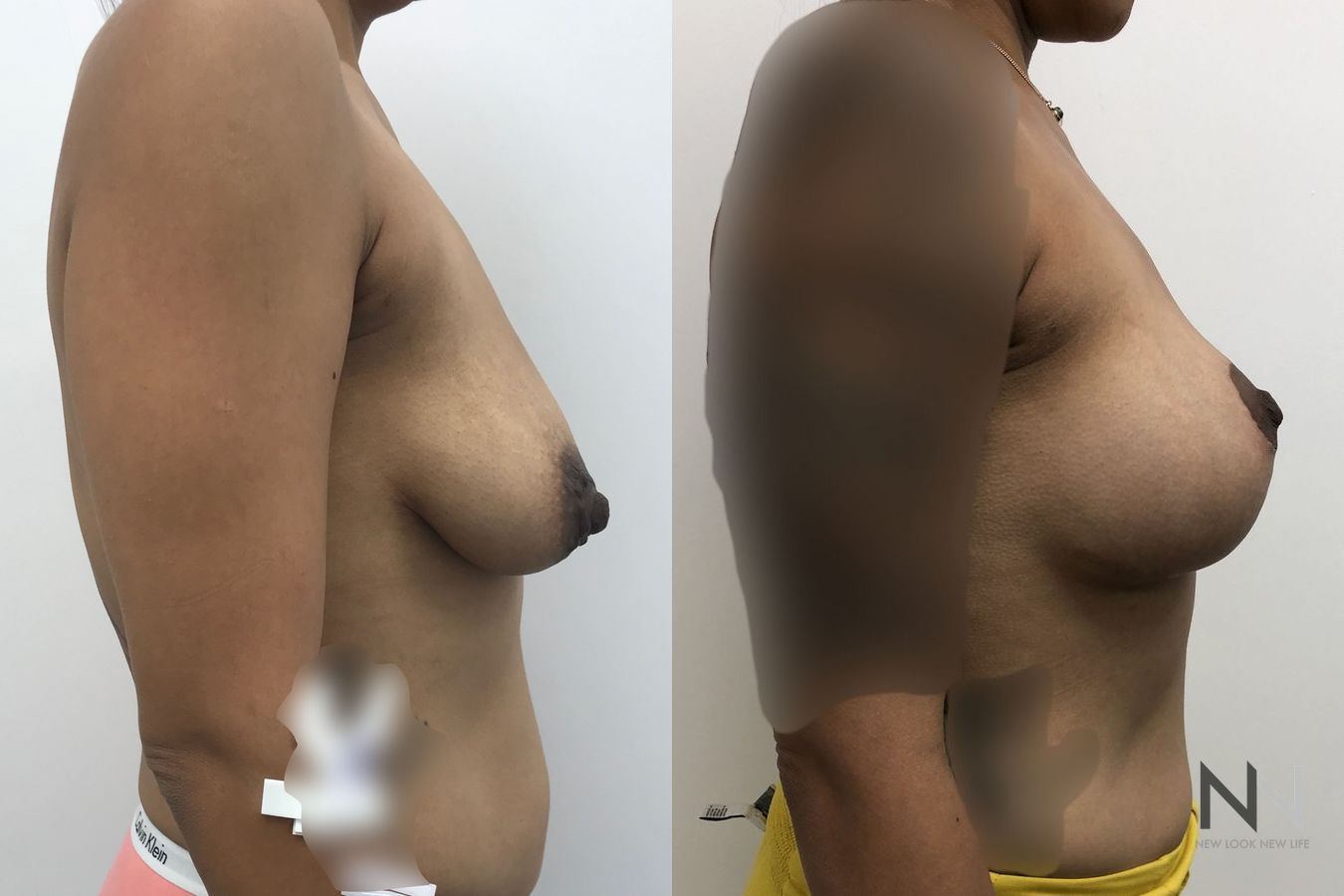Mastopexy with augmentation showing improved contour - Angle 4