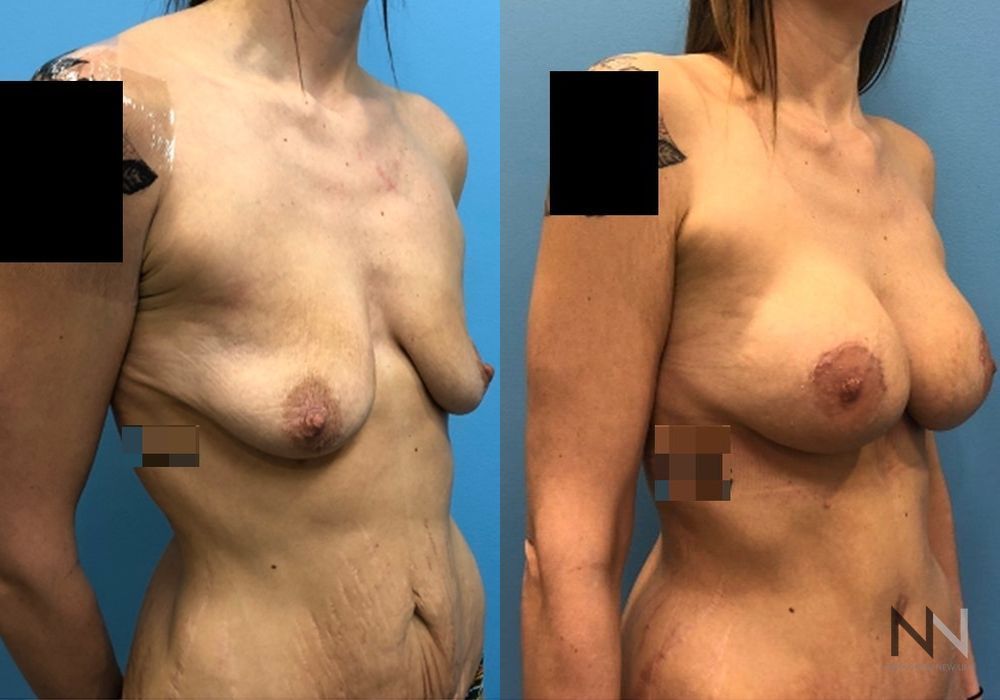 Breast Lift - Thumbnail 2