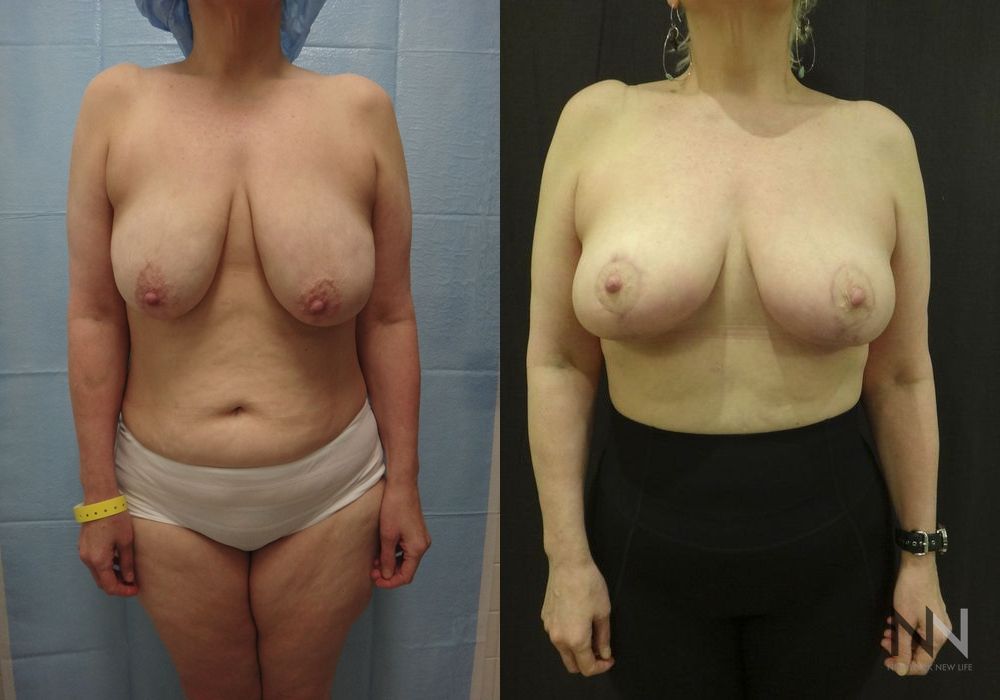 Breast Lift - Case 1835