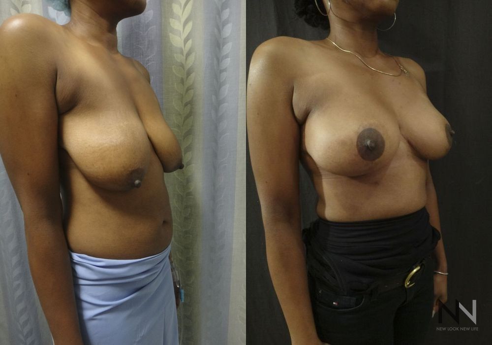Breast Lift - Thumbnail 4
