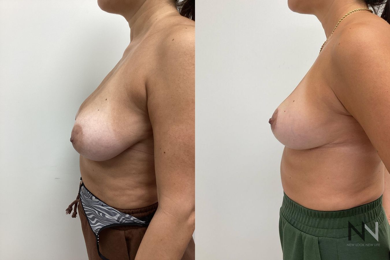 Mastopexy showing elevated breast contour and symmetry - Angle 2