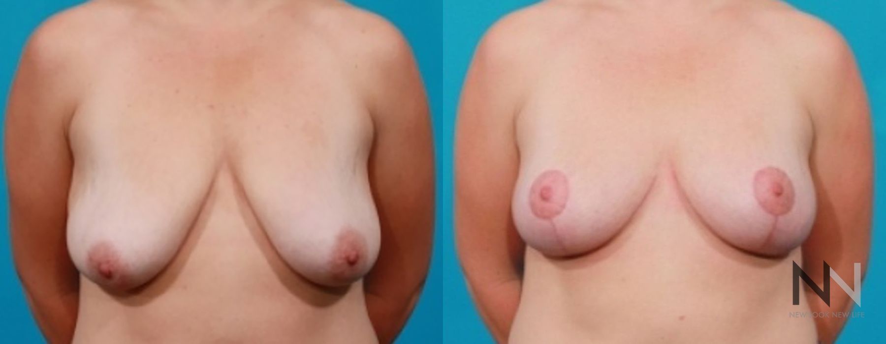 Breast Lift - Case 2027