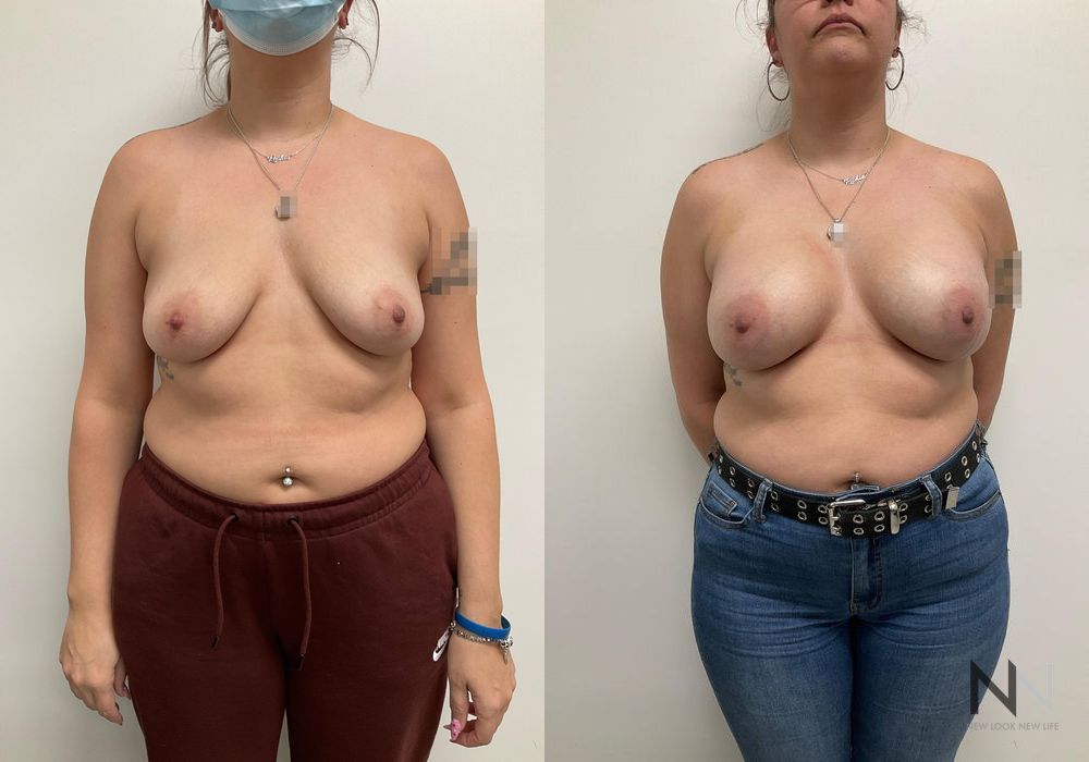 Breast Lift - Case 2015