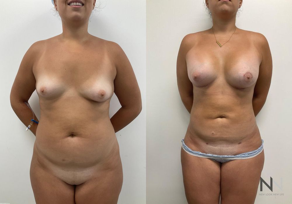 Breast Lift - Thumbnail 2