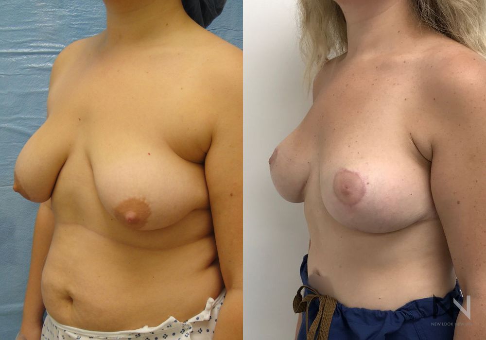 Breast Lift - Thumbnail 3