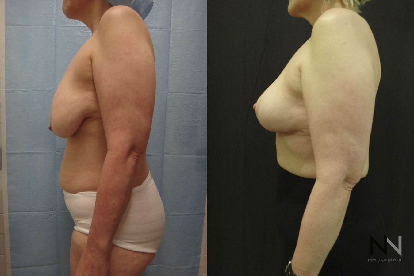 Breast lift results with improved support and contour - Angle 4