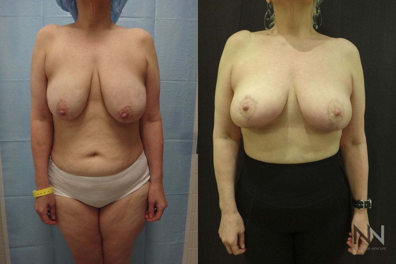 Breast lift results with improved support and contour