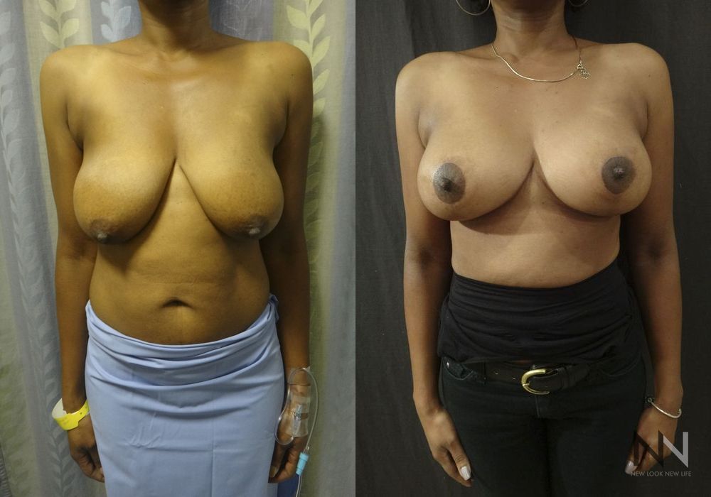 Breast Lift - Case 2018