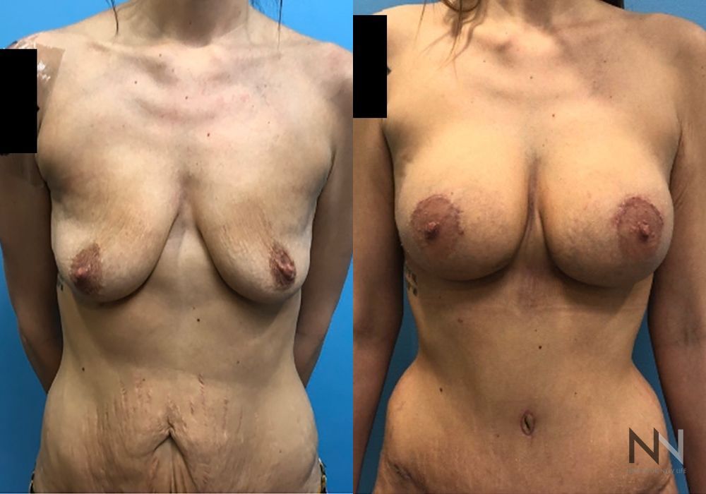 Breast Lift - Case 2033