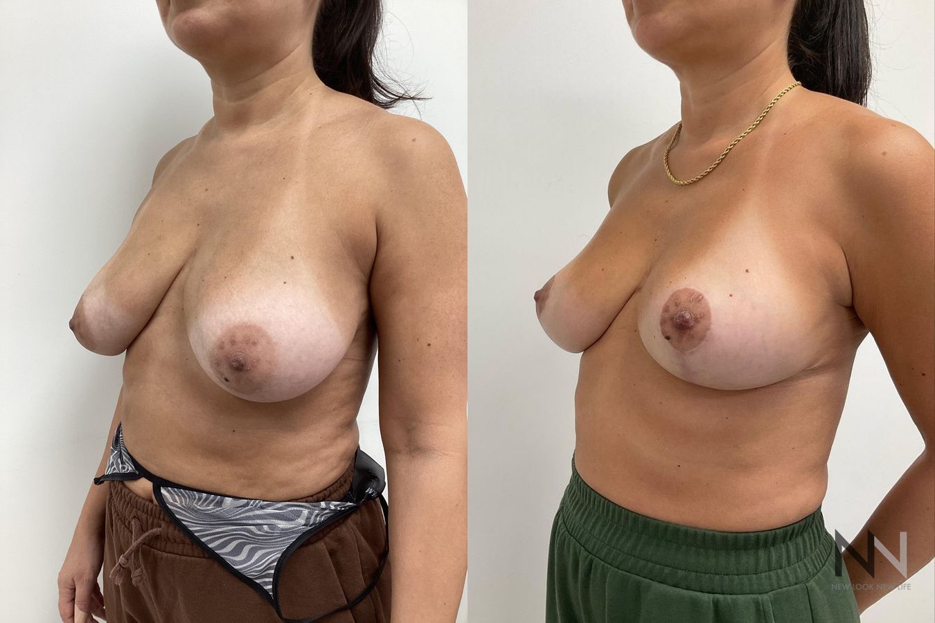Mastopexy showing elevated breast contour and symmetry