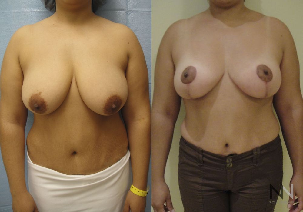Breast Lift - Case 2021