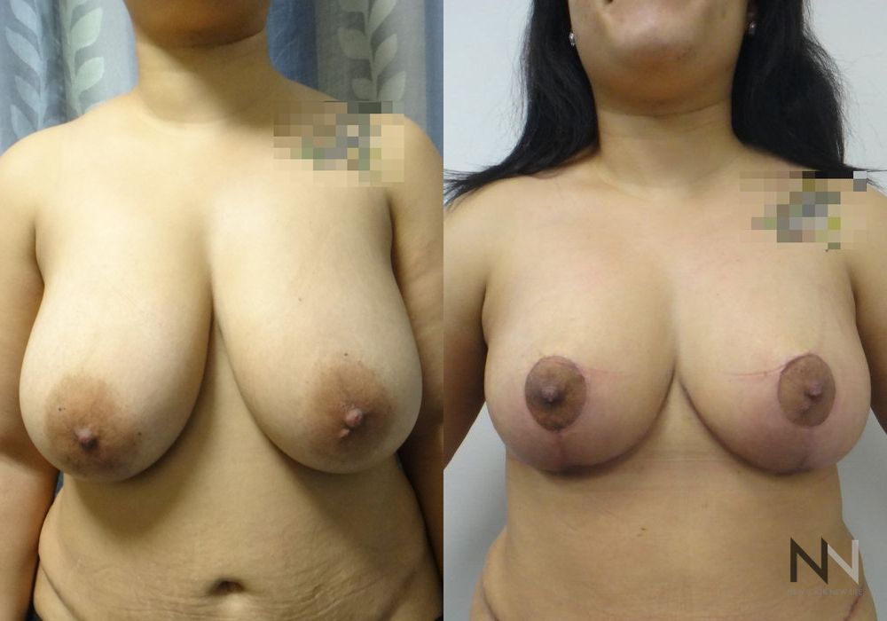Breast Lift - Case 1838